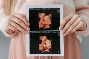 a imagem mostra uma mulher com o resultado de um ultrassom