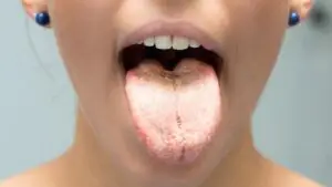 A imagem mostra uma mulher mostrando a língua com candidíase.