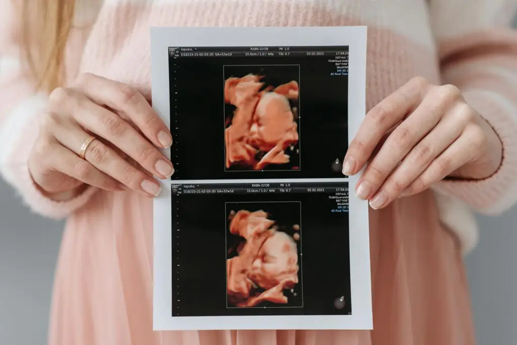 a imagem mostra uma mulher com o resultado de um ultrassom